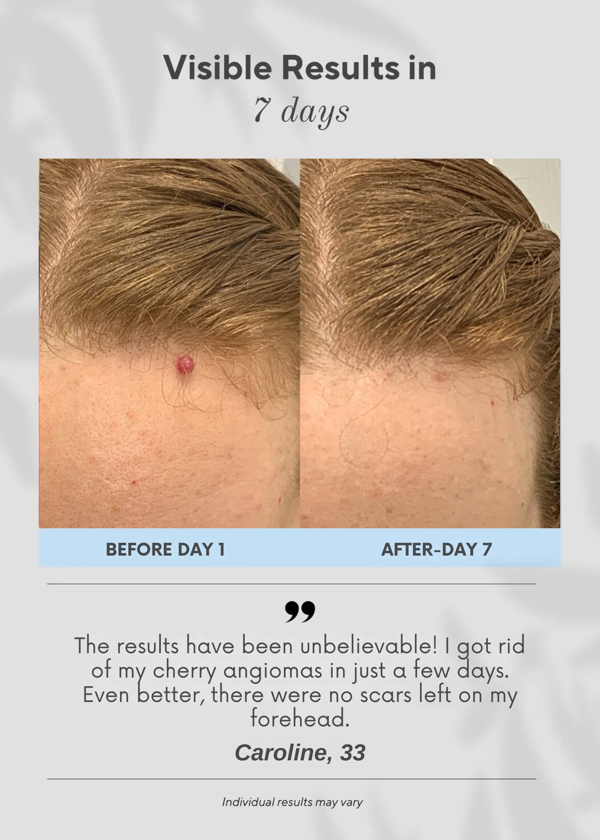 6-in-1 Cherry Angiomas Removal Pen