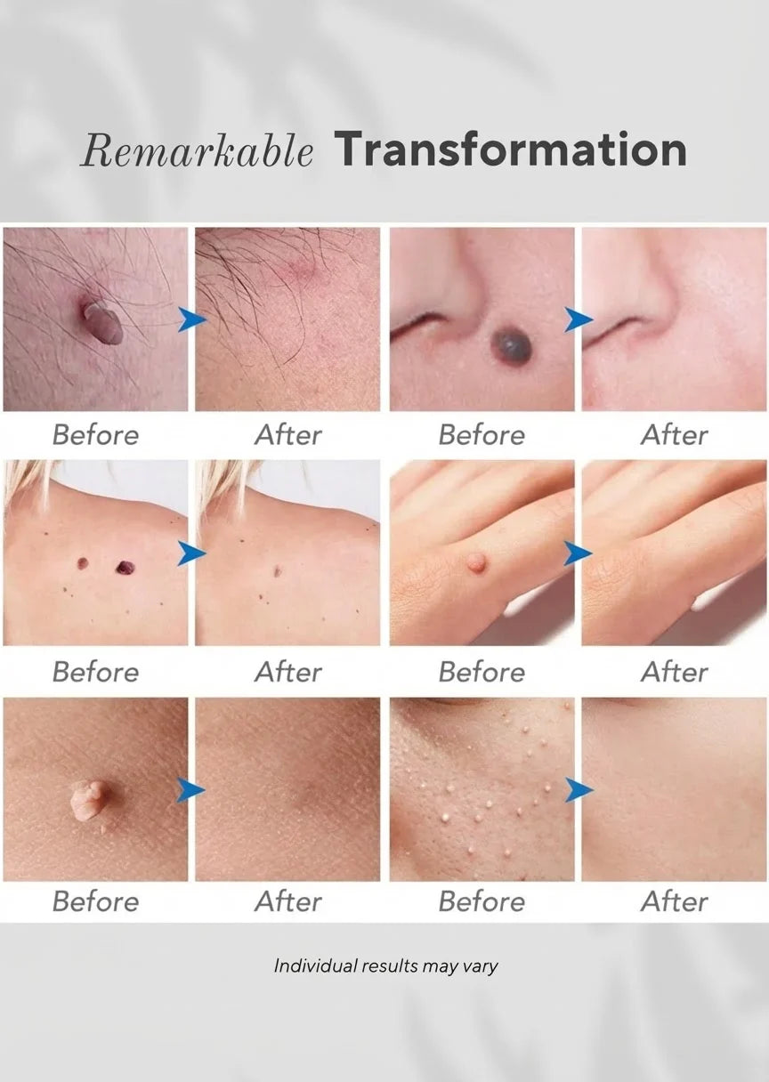 6-in-1 Milia Removal Pen